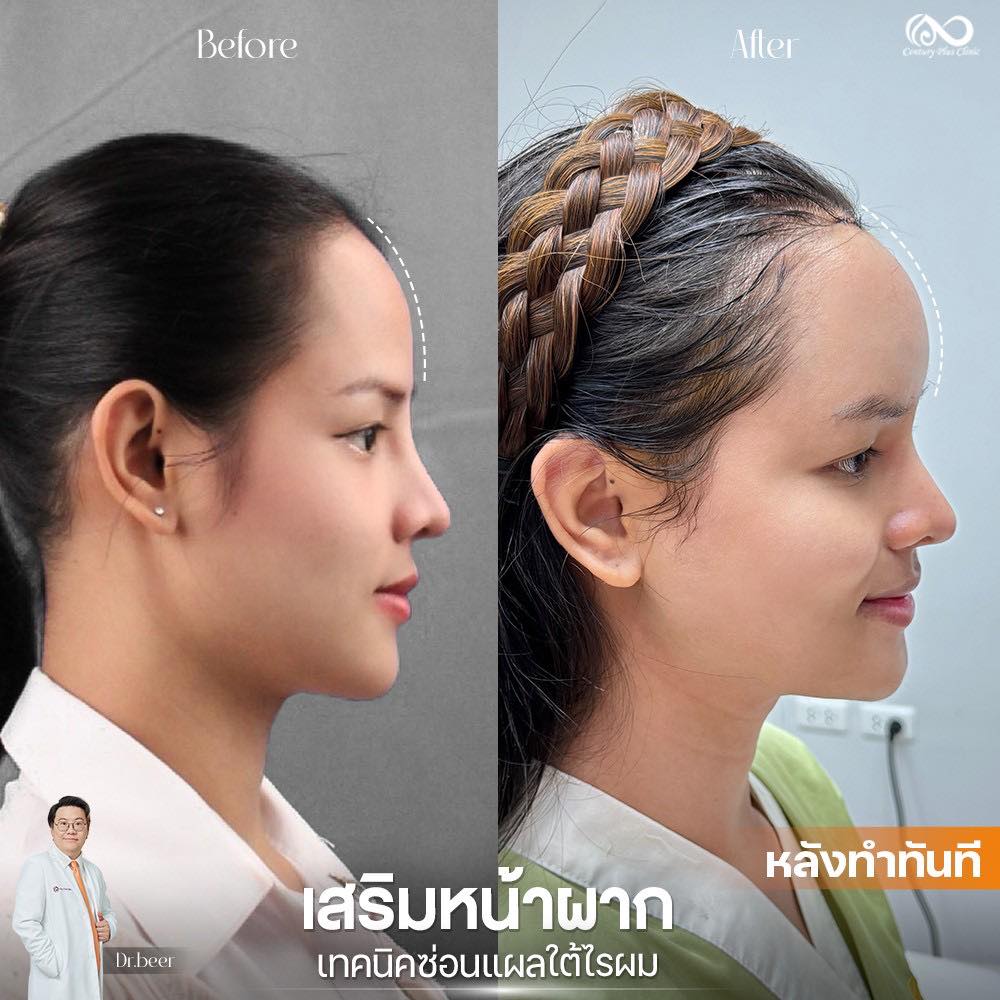 รีวิว เสริมหน้าผาก #39 , Century Clinic Thailand เสริมหน้าผาก 1#39