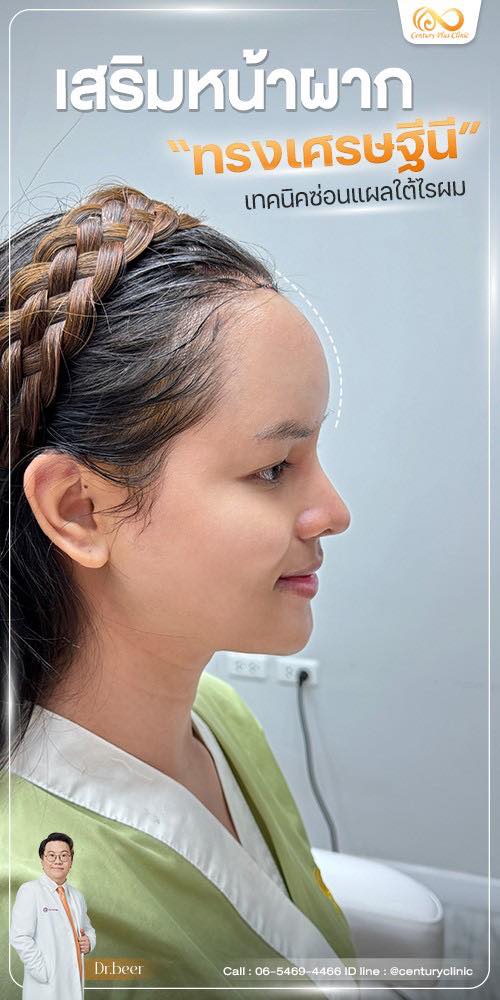 รีวิว เสริมหน้าผาก #39