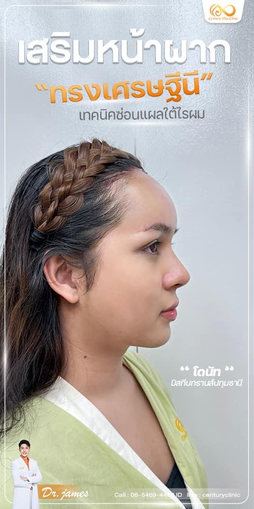 เสริมหน้าผาก #42