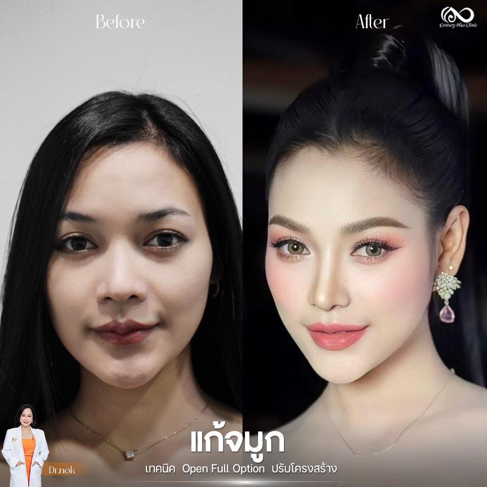 แก้จมูก #1197