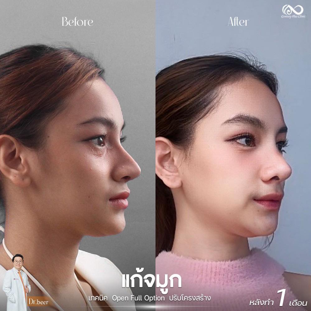 แก้จมูก 1#1207