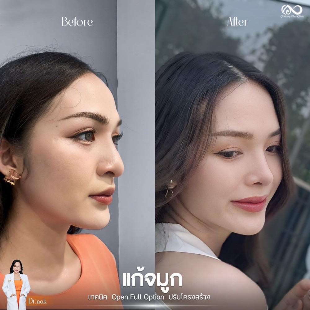 รีวิว แก้จมูก #1212 , Century Clinic Thailand แก้จมูก 1#1212