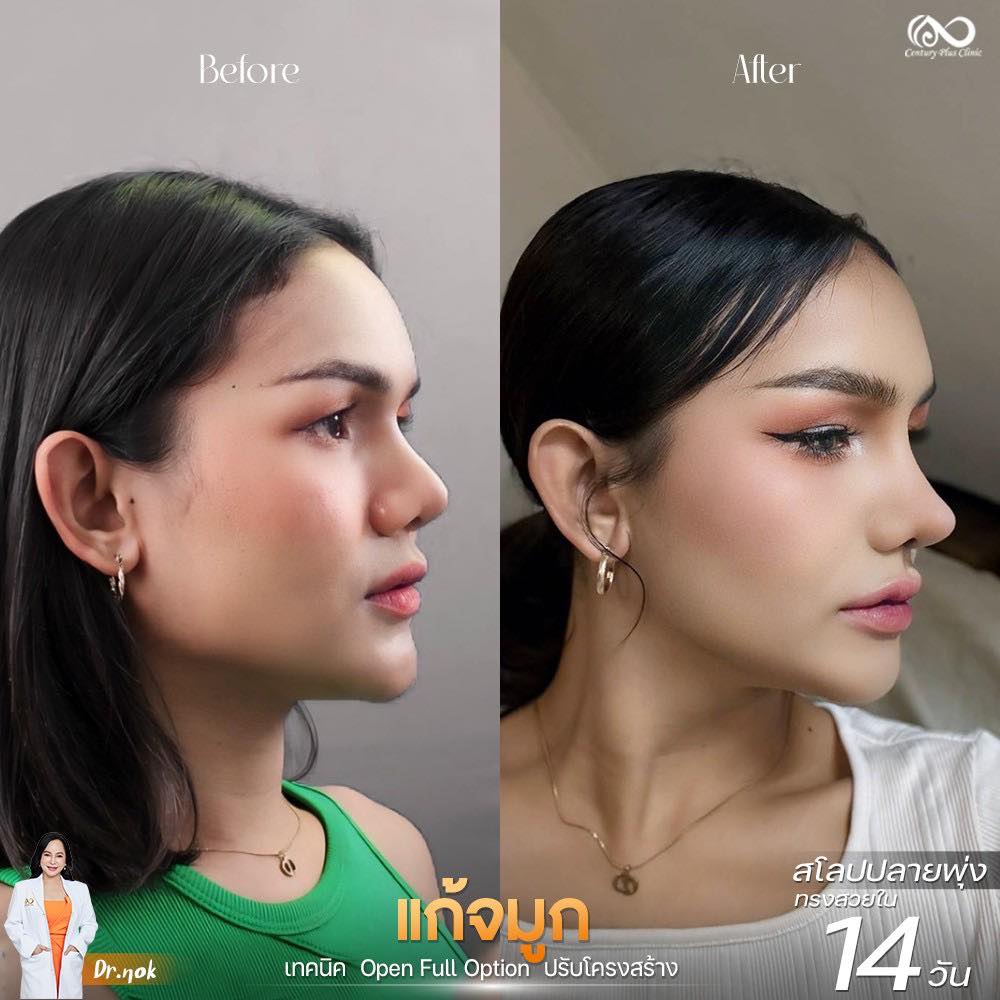 แก้จมูก 1#1230
