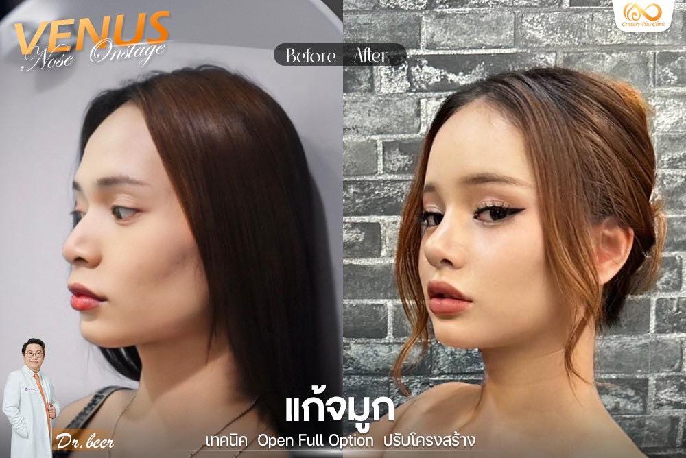 แก้จมูก 1#1232