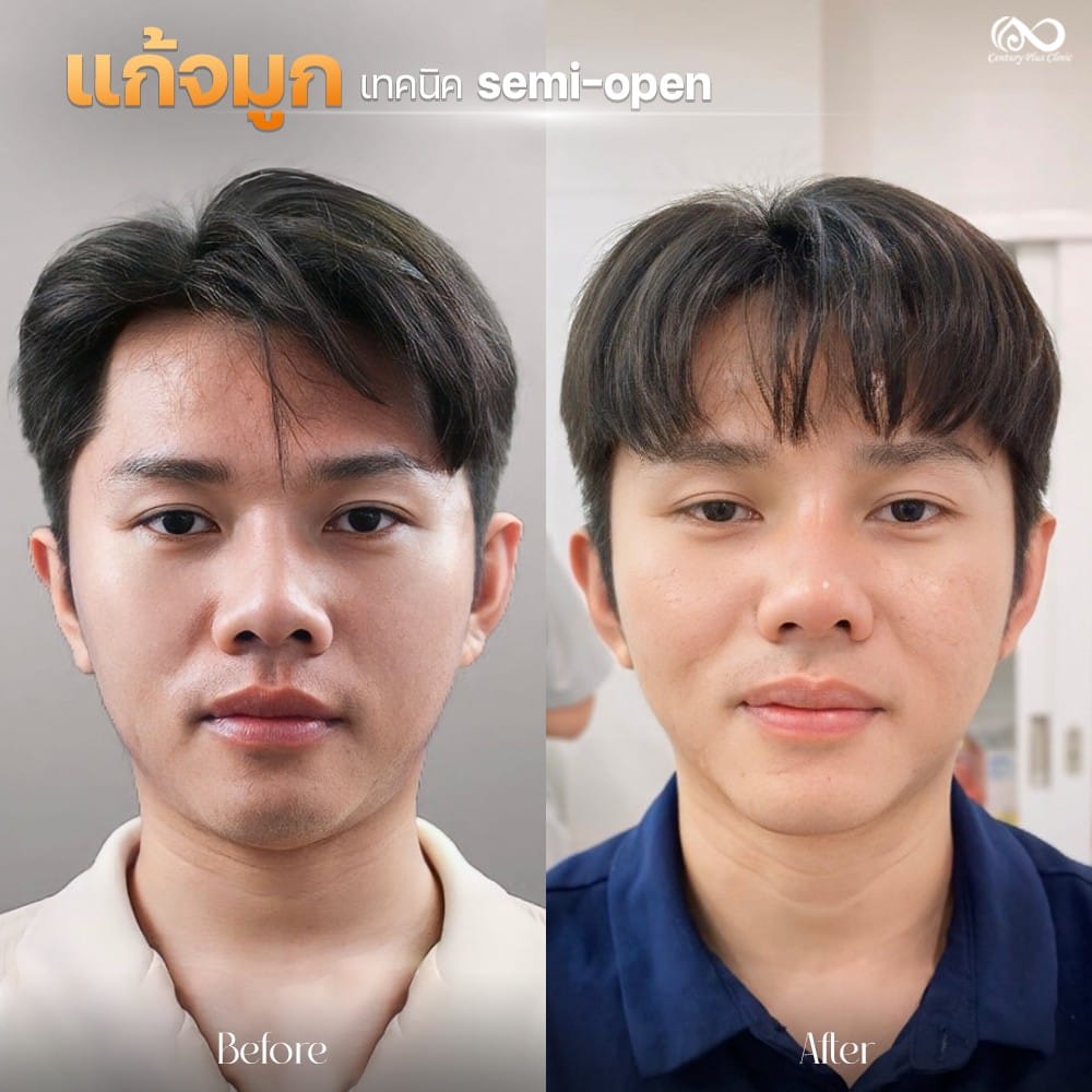 แก้จมูก 1#1237