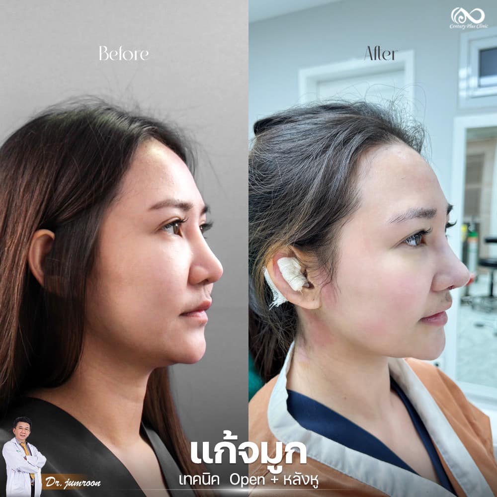 แก้จมูก 1#1239