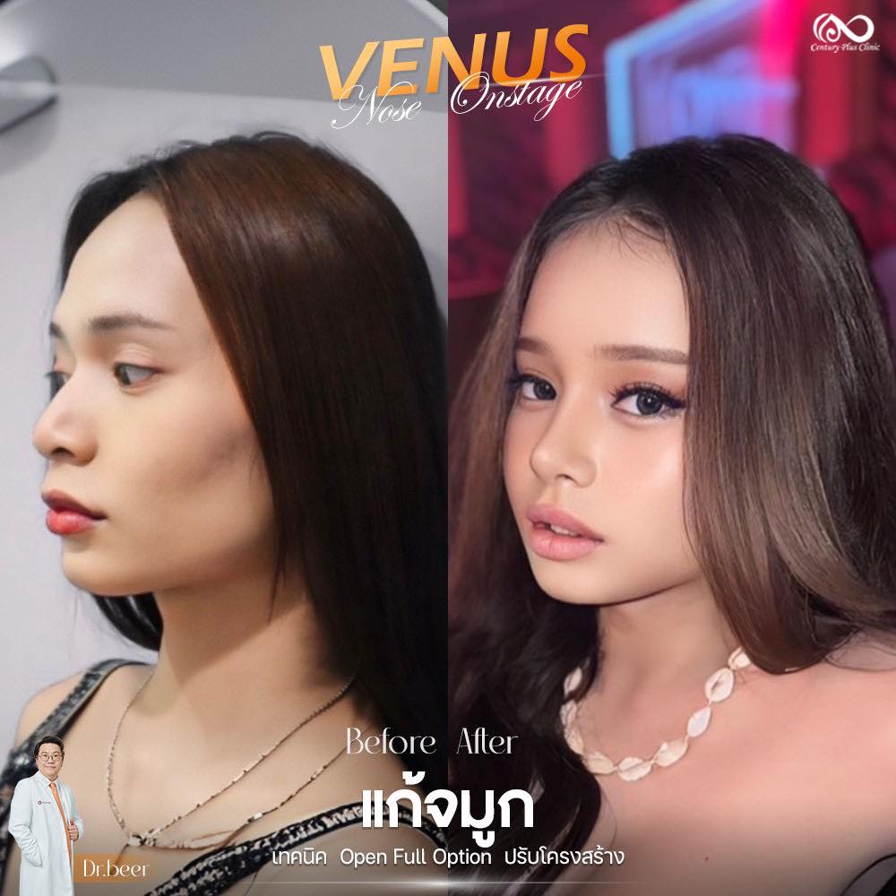 แก้จมูก #1215
