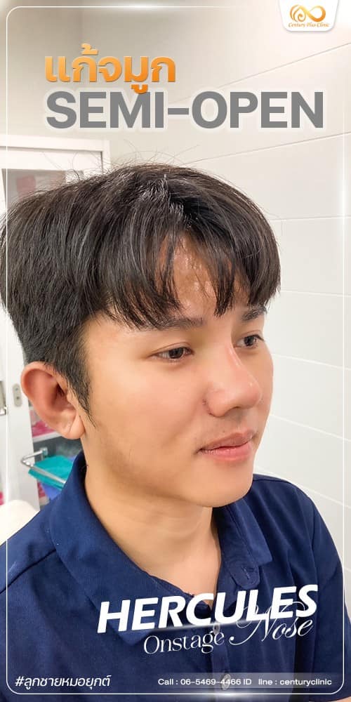 แก้จมูก #1237