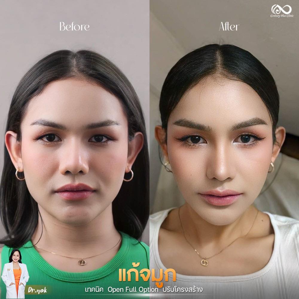 แก้จมูก 2#1230