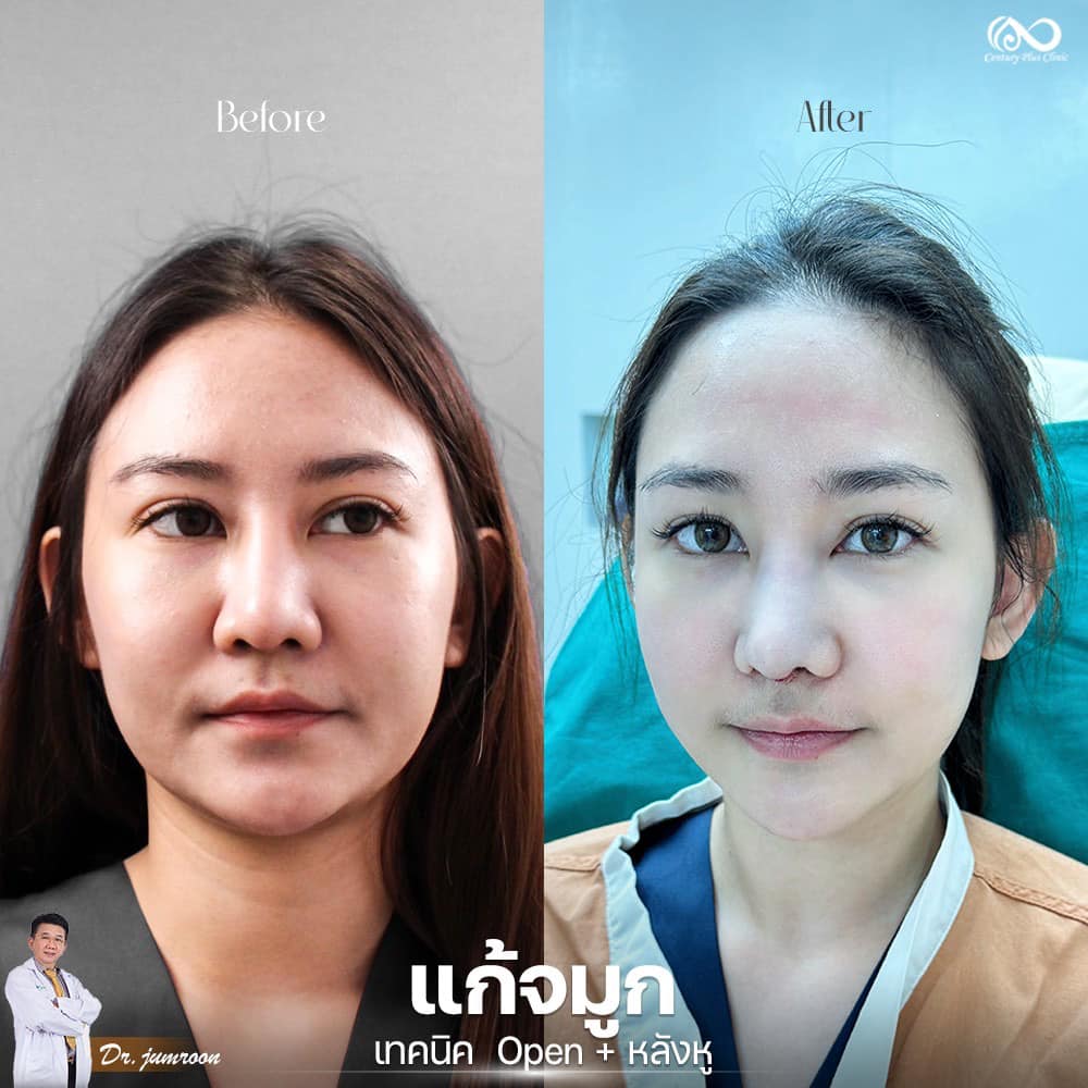 แก้จมูก 2#1239