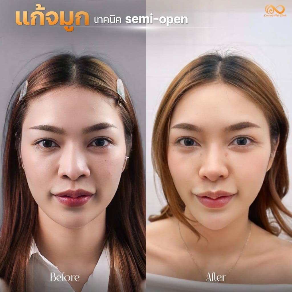 แก้จมูก 2#1240