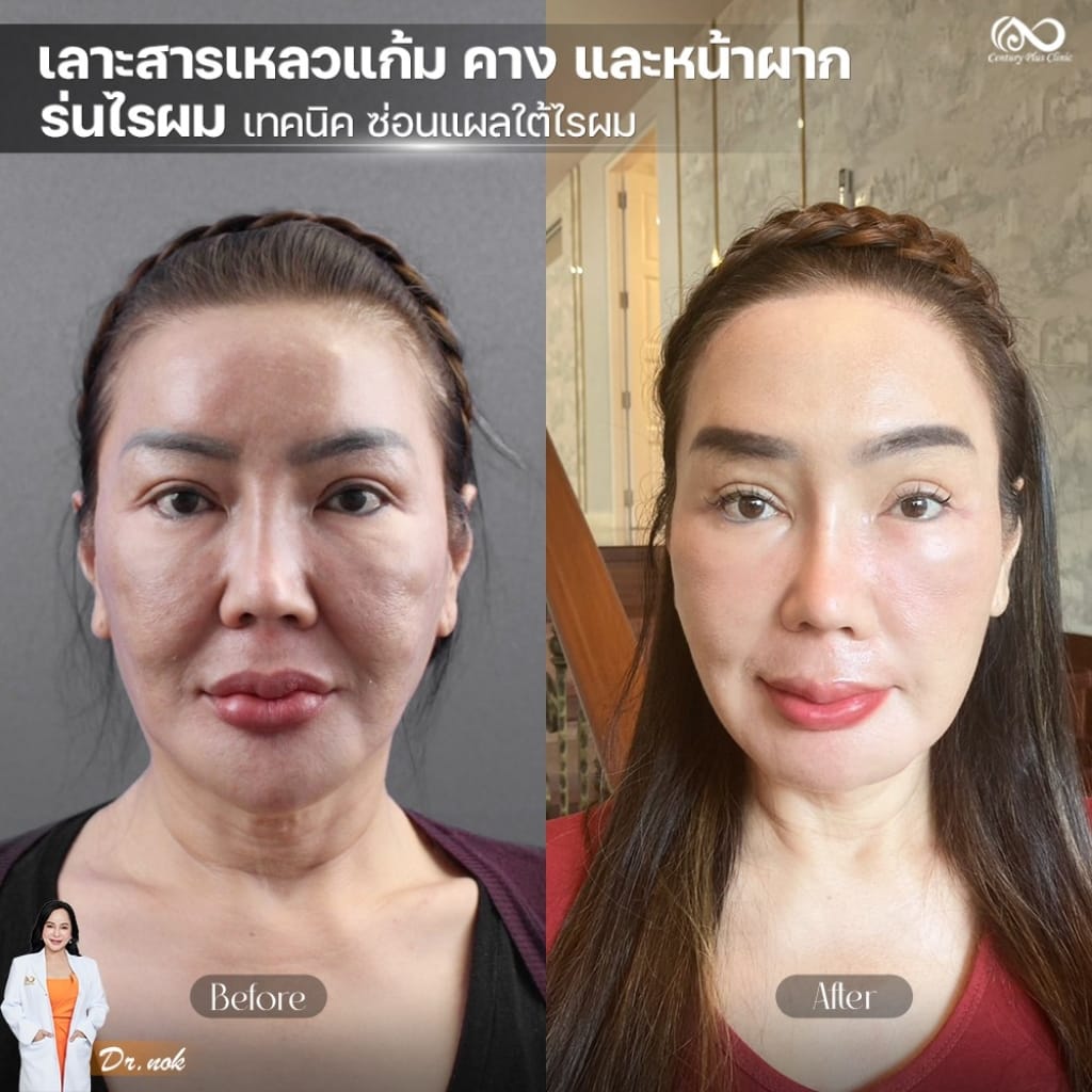 รีวิว หน้าผาก 2#45
