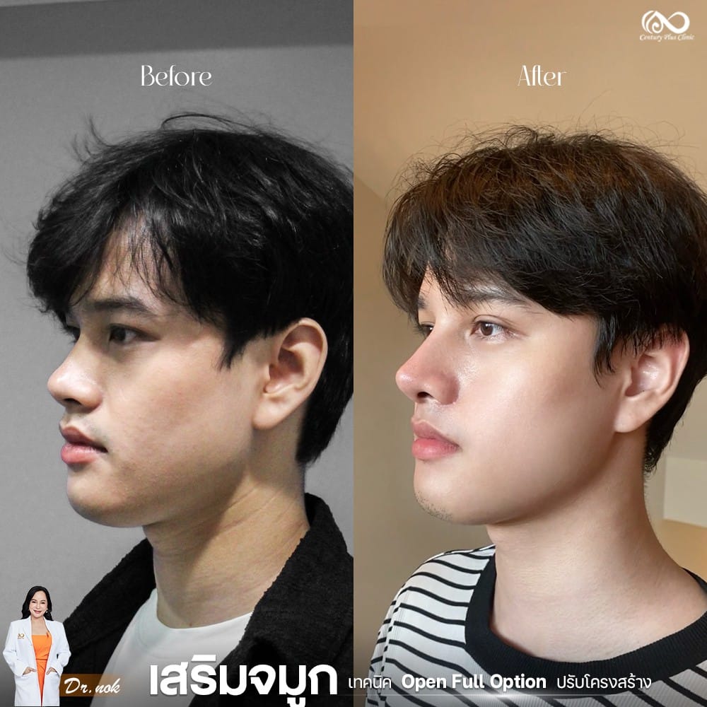 เสริมจมูก 1#1256