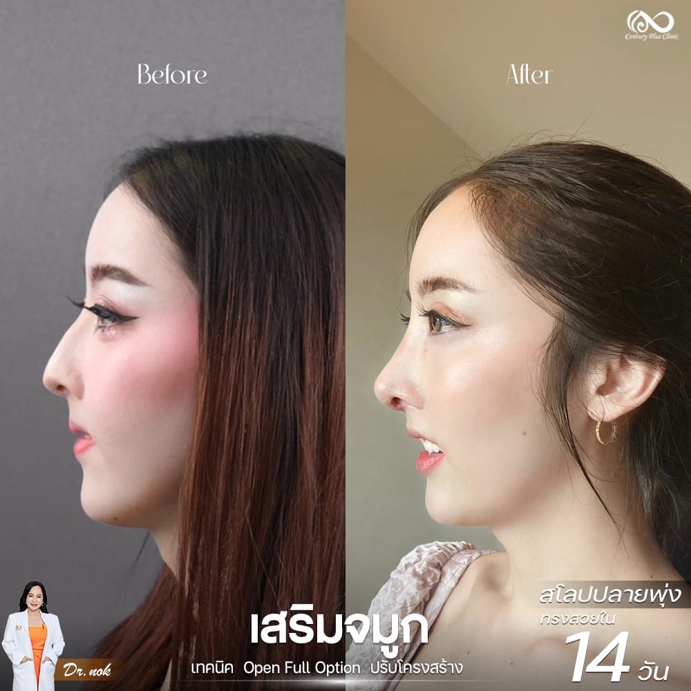 เสริมจมูก 1#1262