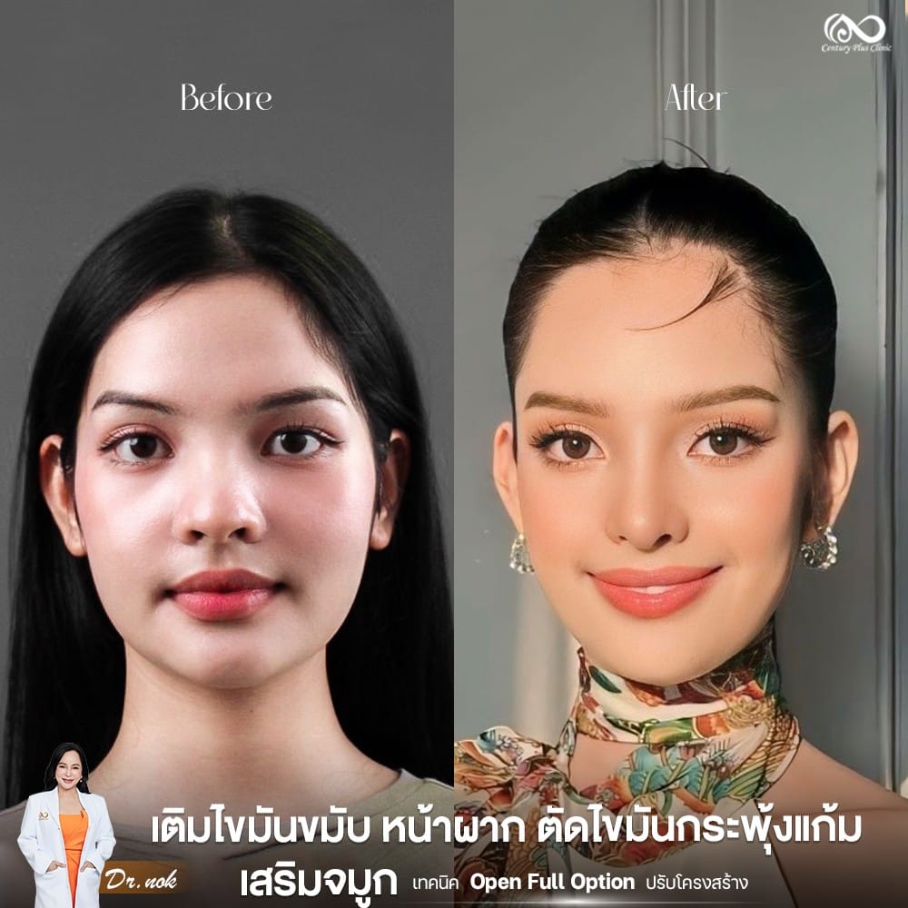 เสริมจมูก 1#1263