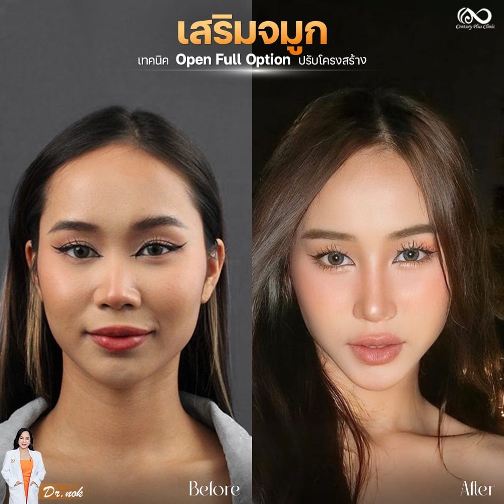 เสริมจมูก 1#1279
