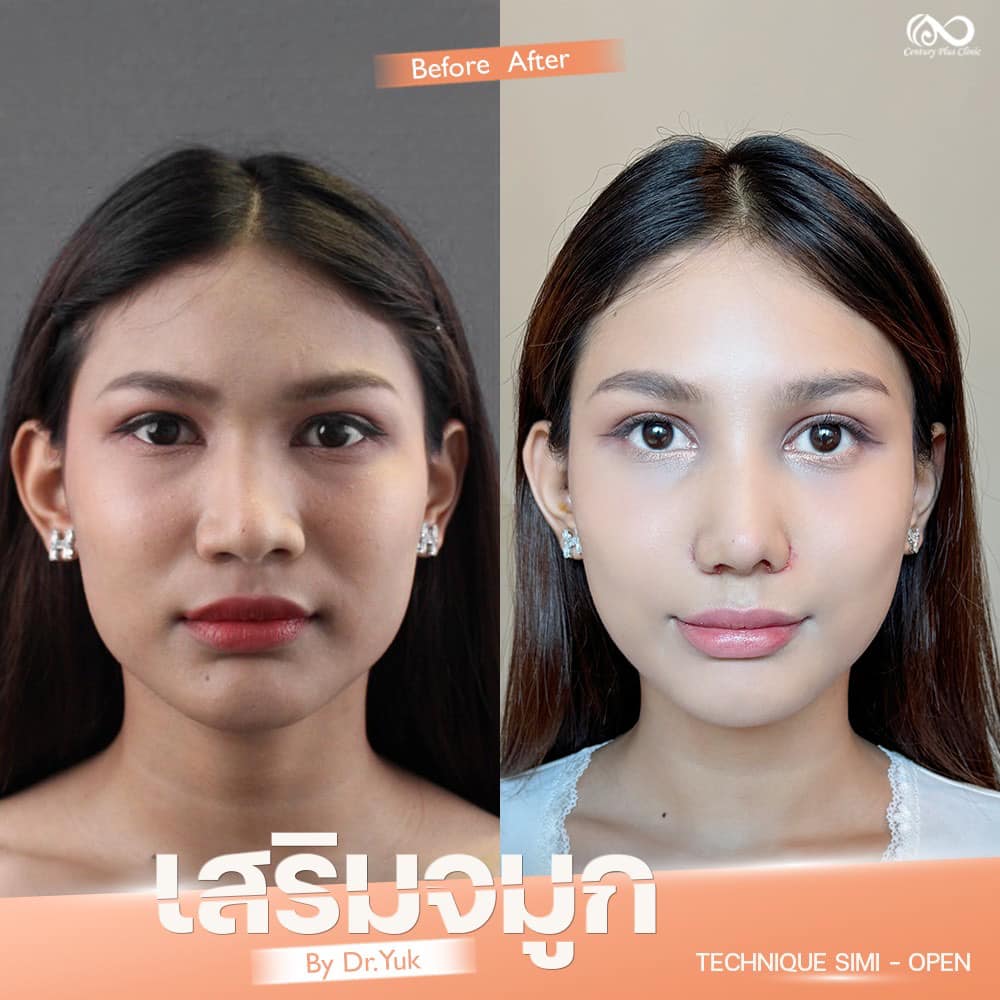 เสริมจมูก 1#1300