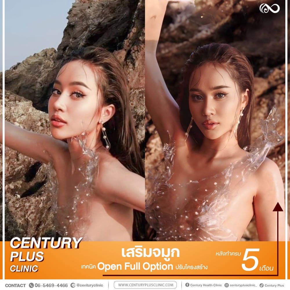 เสริมจมูก #1306