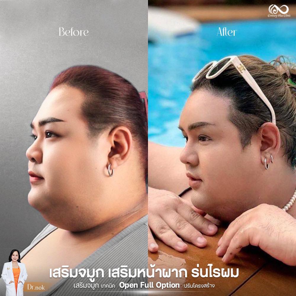 เสริมจมูก 2#1252