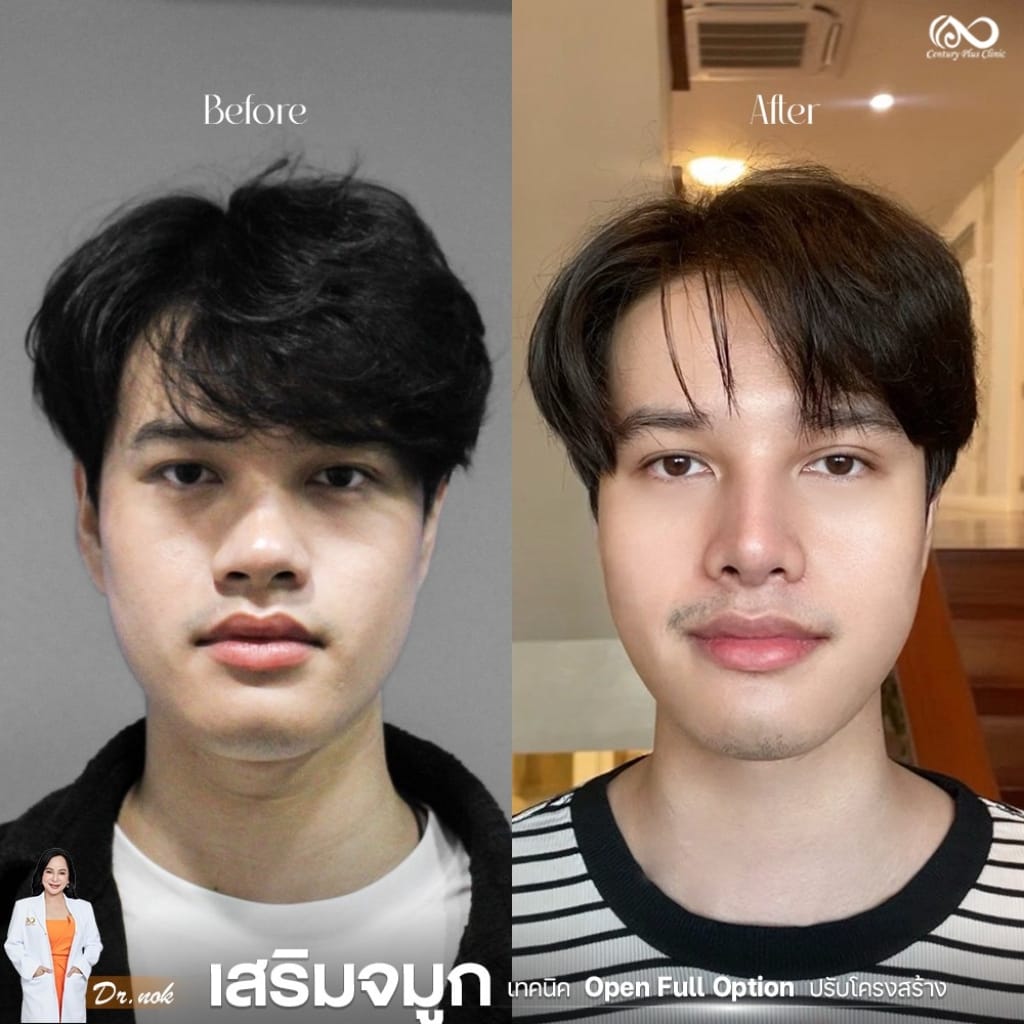 เสริมจมูก 2#1256