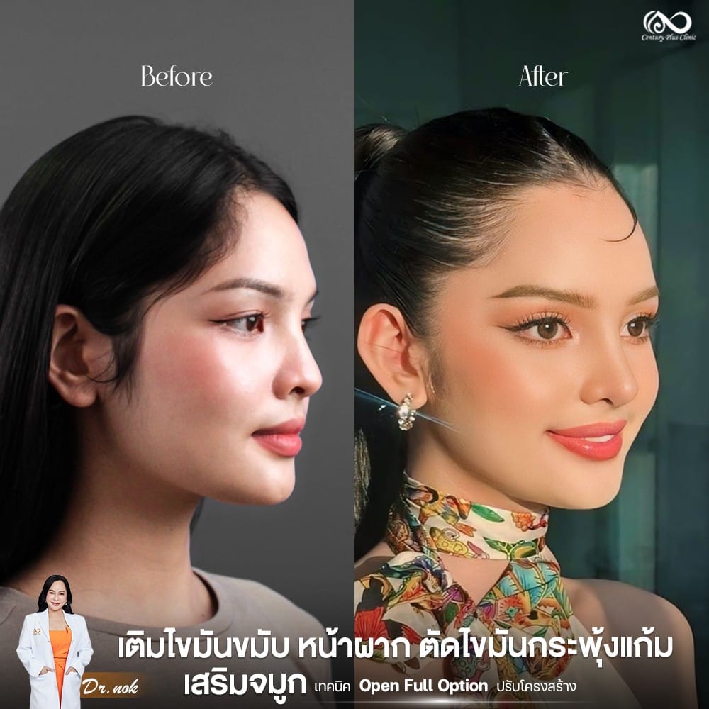 เสริมจมูก 2#1263