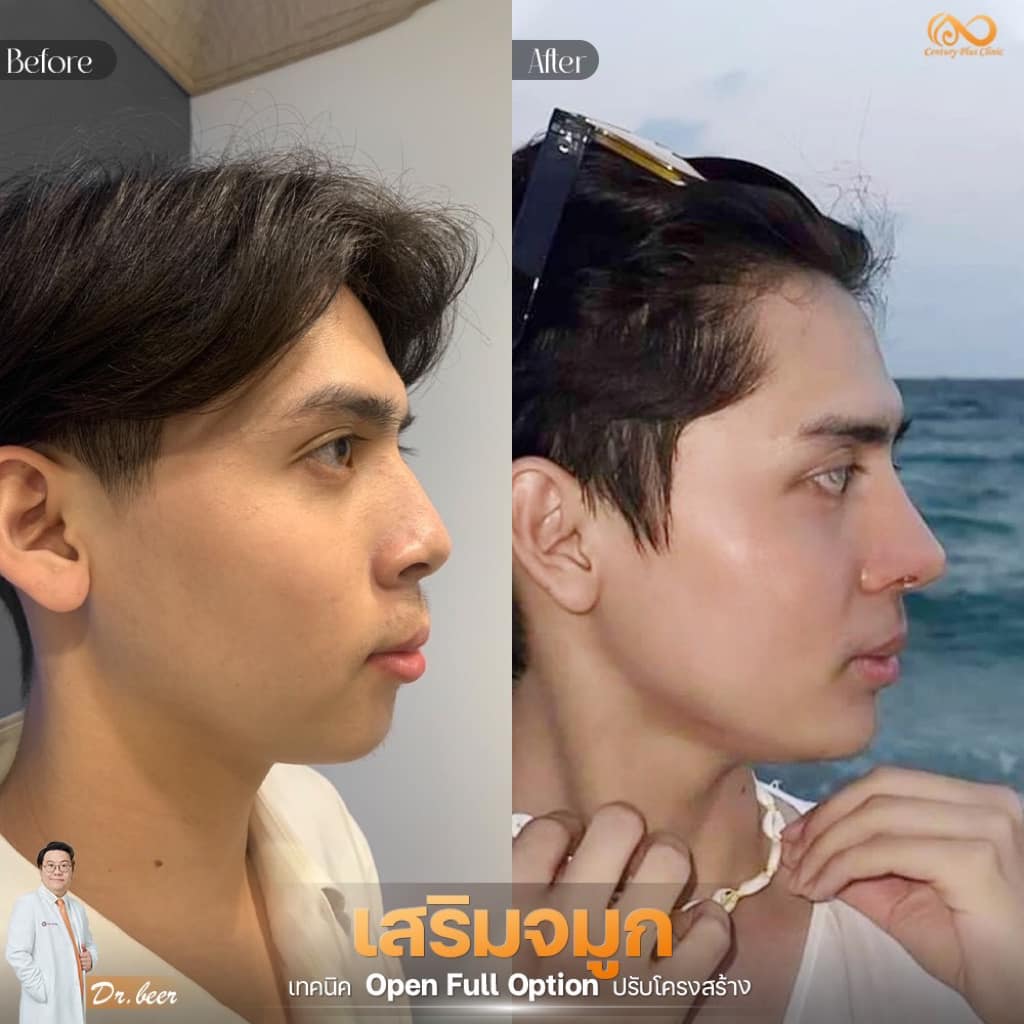 เสริมจมูก 2#1290