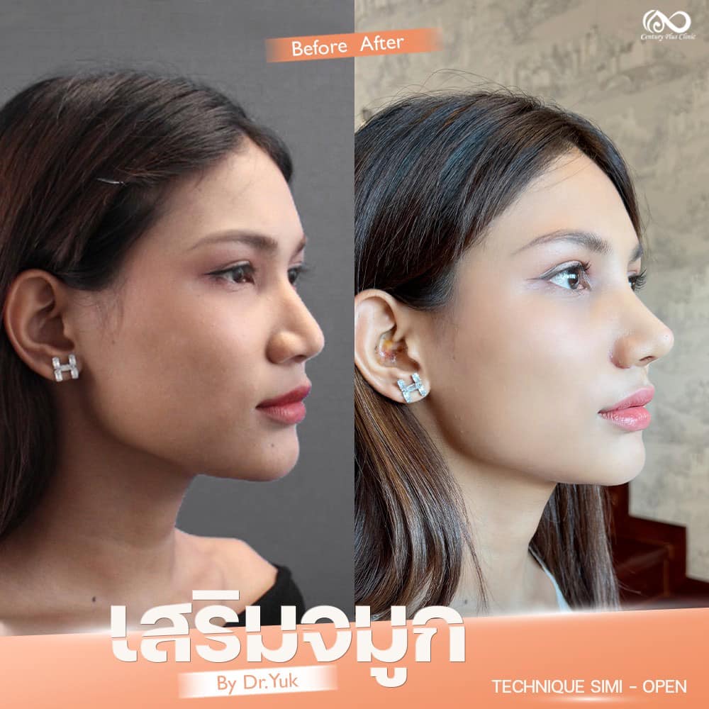 เสริมจมูก 2#1300