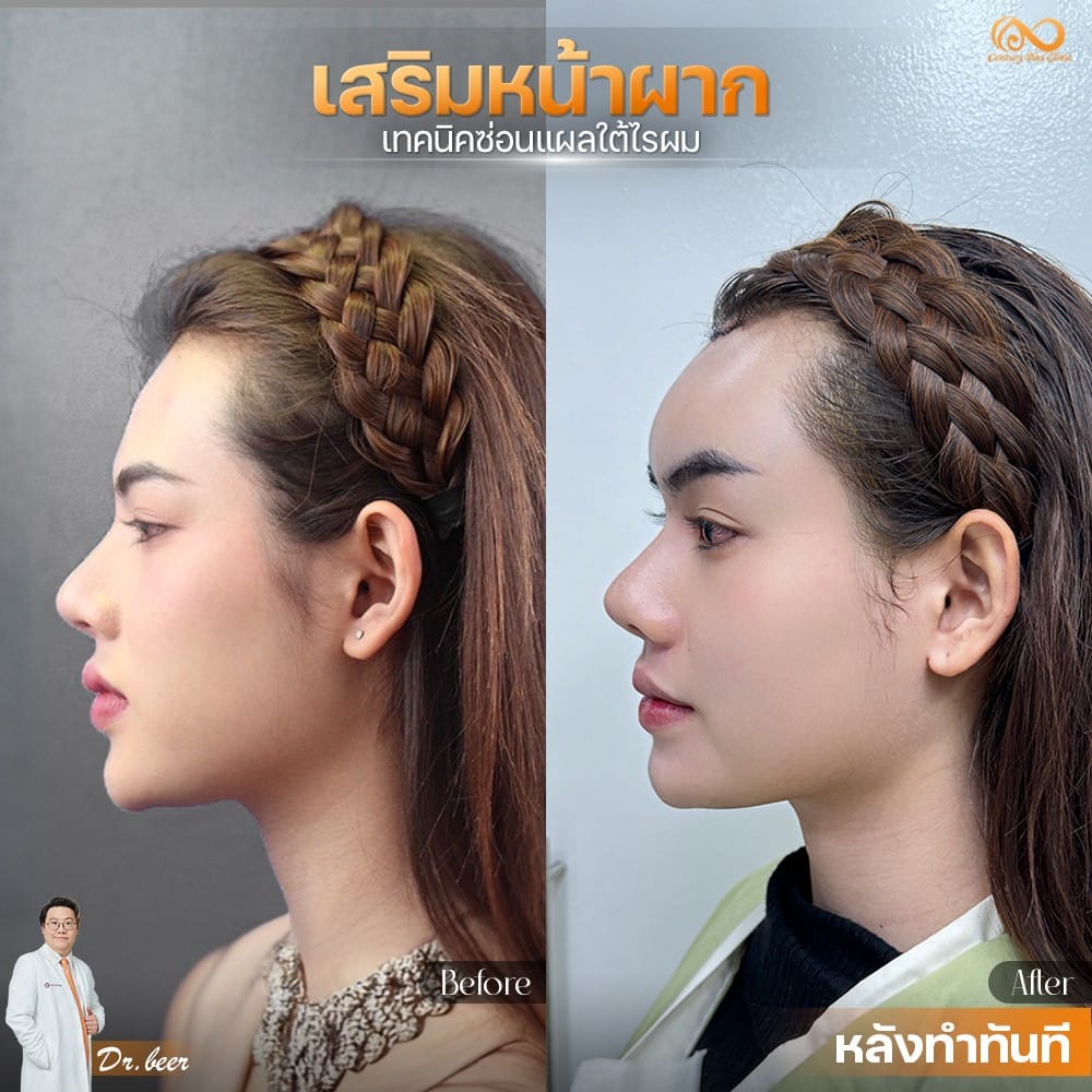 เสริมหน้าผาก 2#46