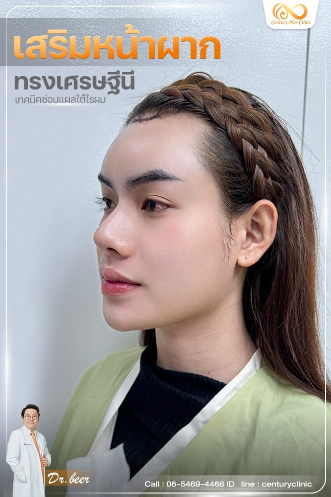 เสริมหน้าผาก #46
