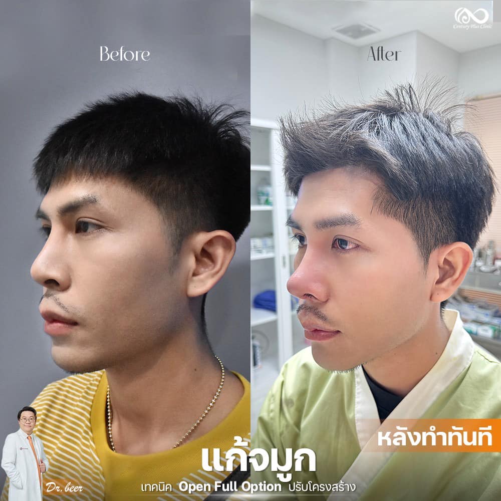 รีวิว แก้จมูก #1259 , Century Clinic Thailand แก้จมูก 1#1259