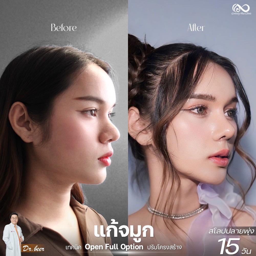 แก้จมูก 1#1264