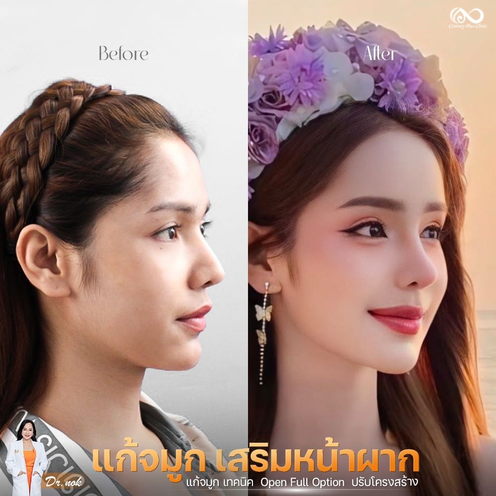 แก้จมูก 1#1266