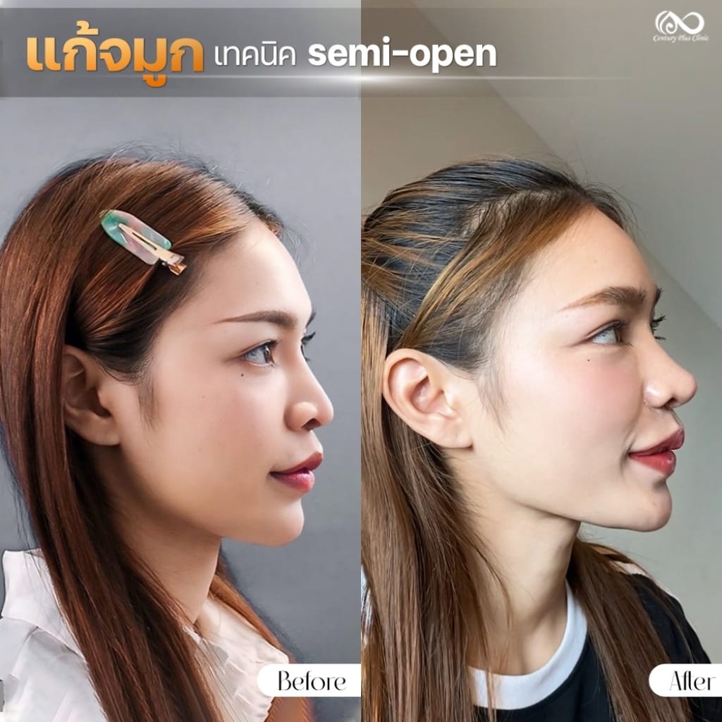 รีวิว แก้จมูก #1275 , Century Clinic Thailand แก้จมูก 1#1275
