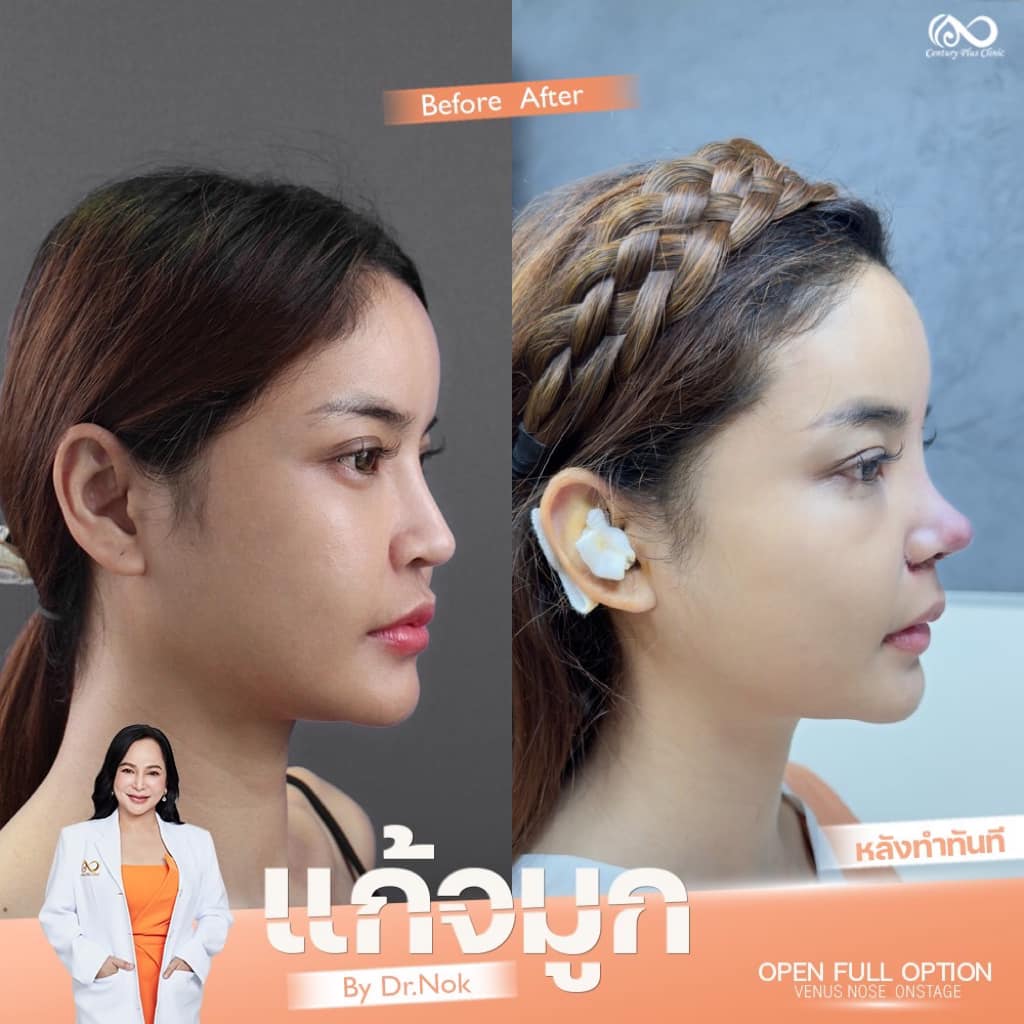 รีวิว แก้จมูก #1304 , Century Clinic Thailand แก้จมูก 1#1304