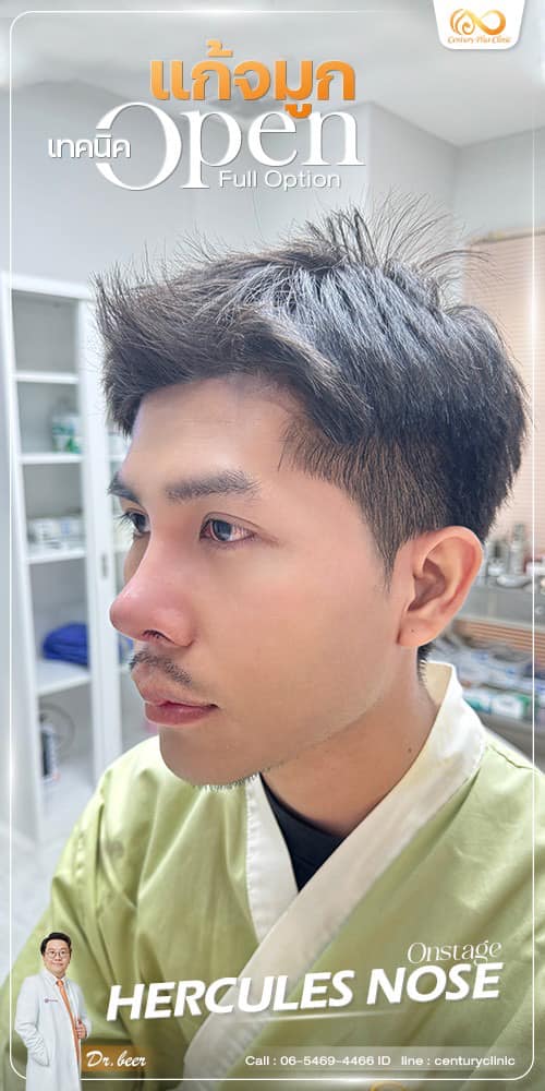 รีวิว แก้จมูก #1259 , Century Clinic Thailand แก้จมูก #1259