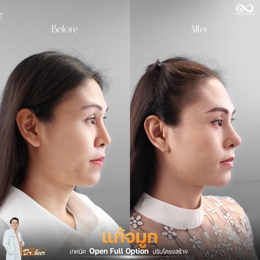 รีวิว แก้จมูก #1269 , Century Clinic Thailand แก้จมูก #1269