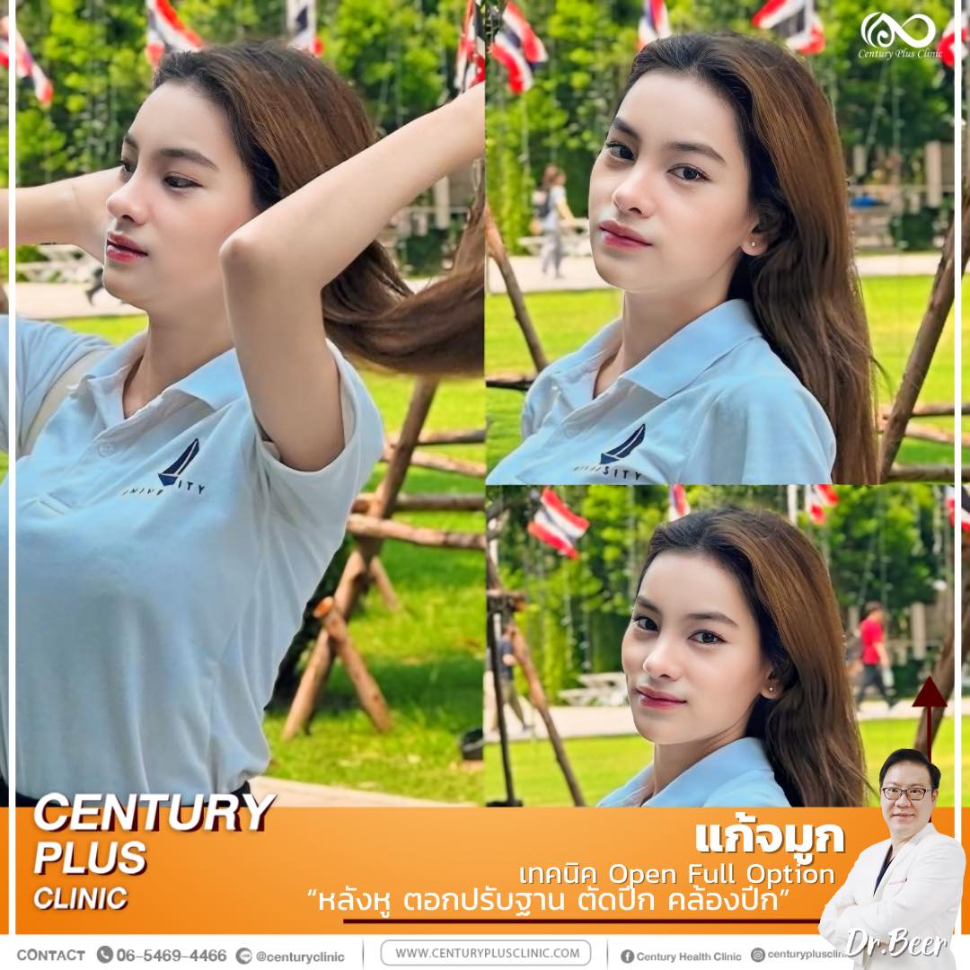 แก้จมูก #1277