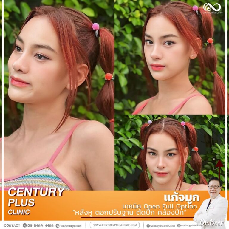 แก้จมูก #1283
