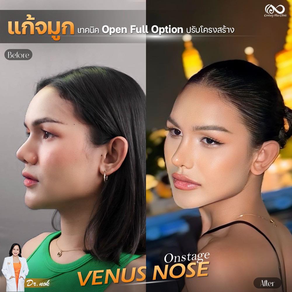 แก้จมูก #1289