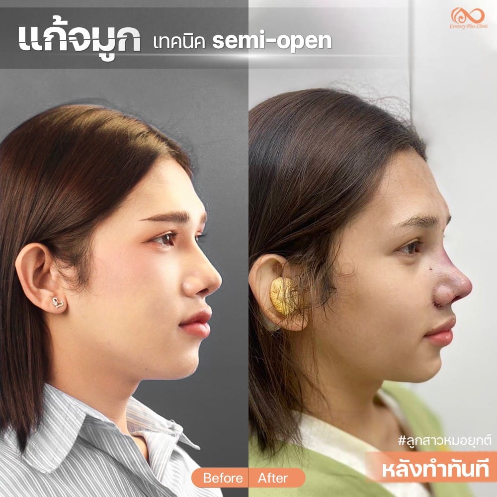 แก้จมูก #1296