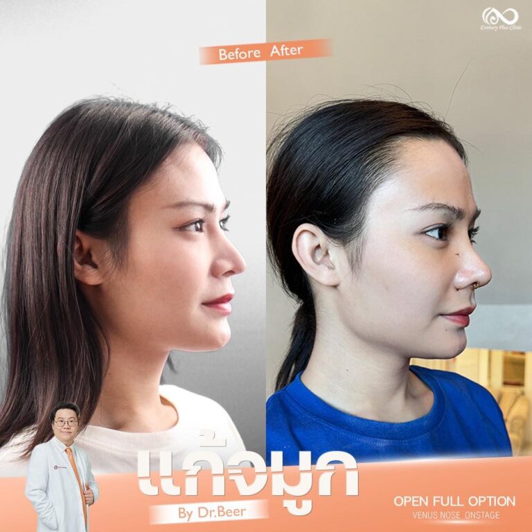 แก้จมูก #1301