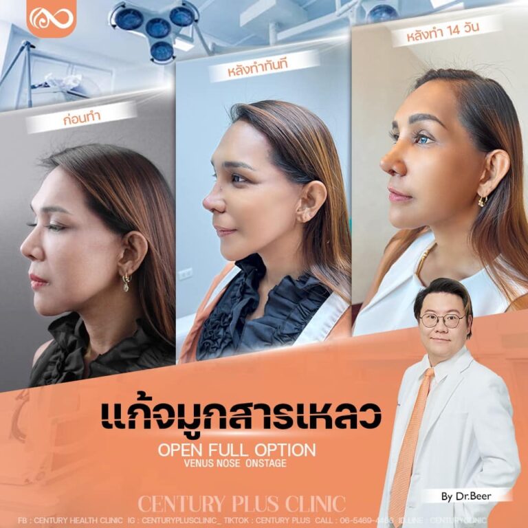 แก้จมูก #1305