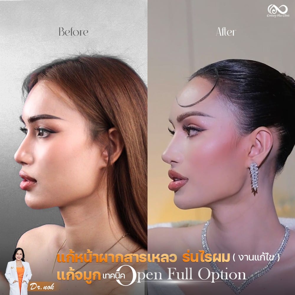 แก้จมูก 2#1255