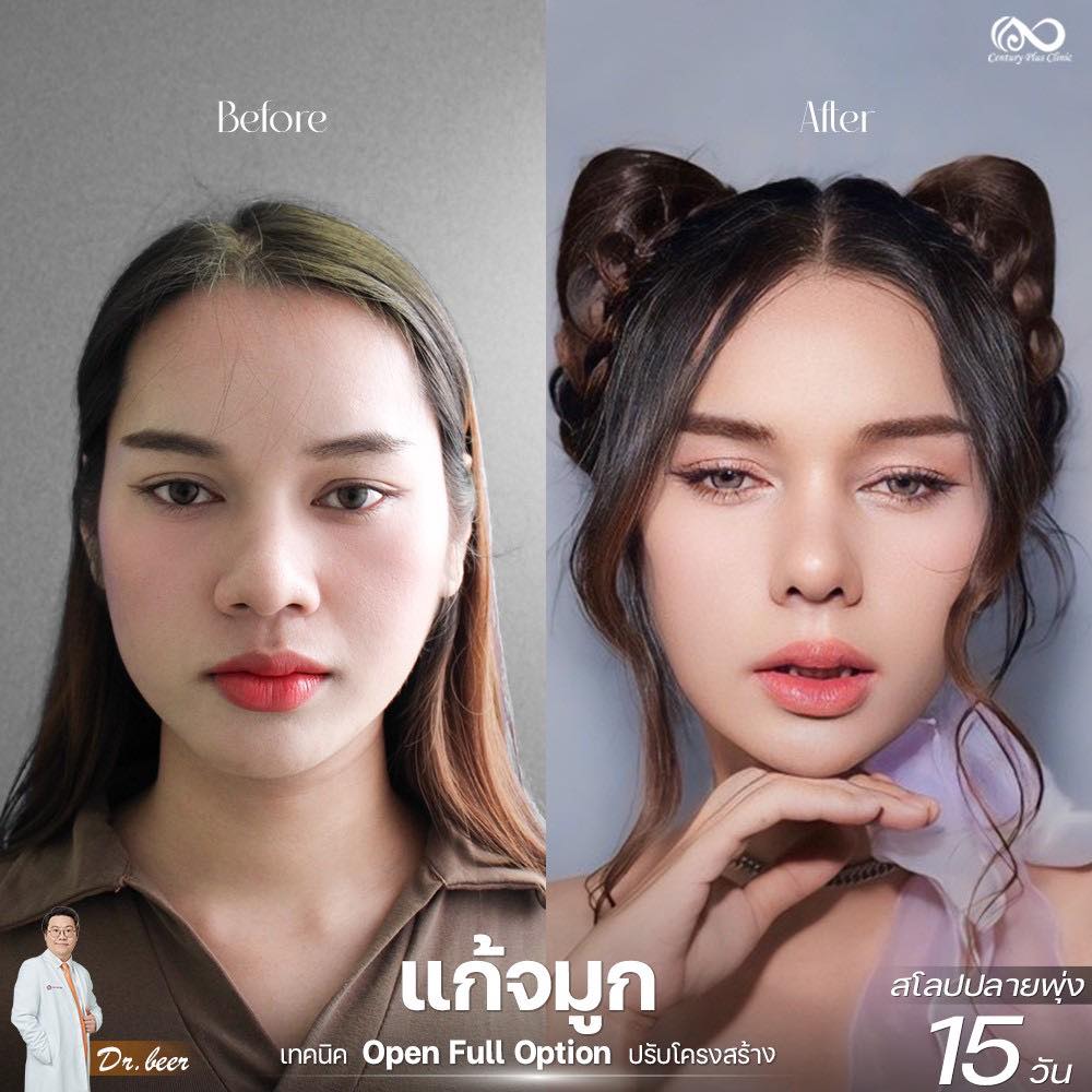 แก้จมูก 2#1264