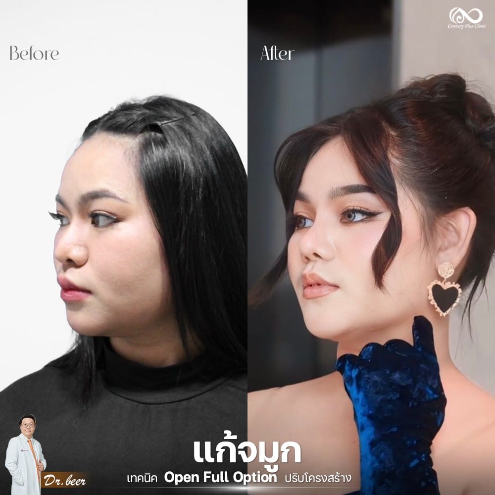 แก้จมูก 2#1267