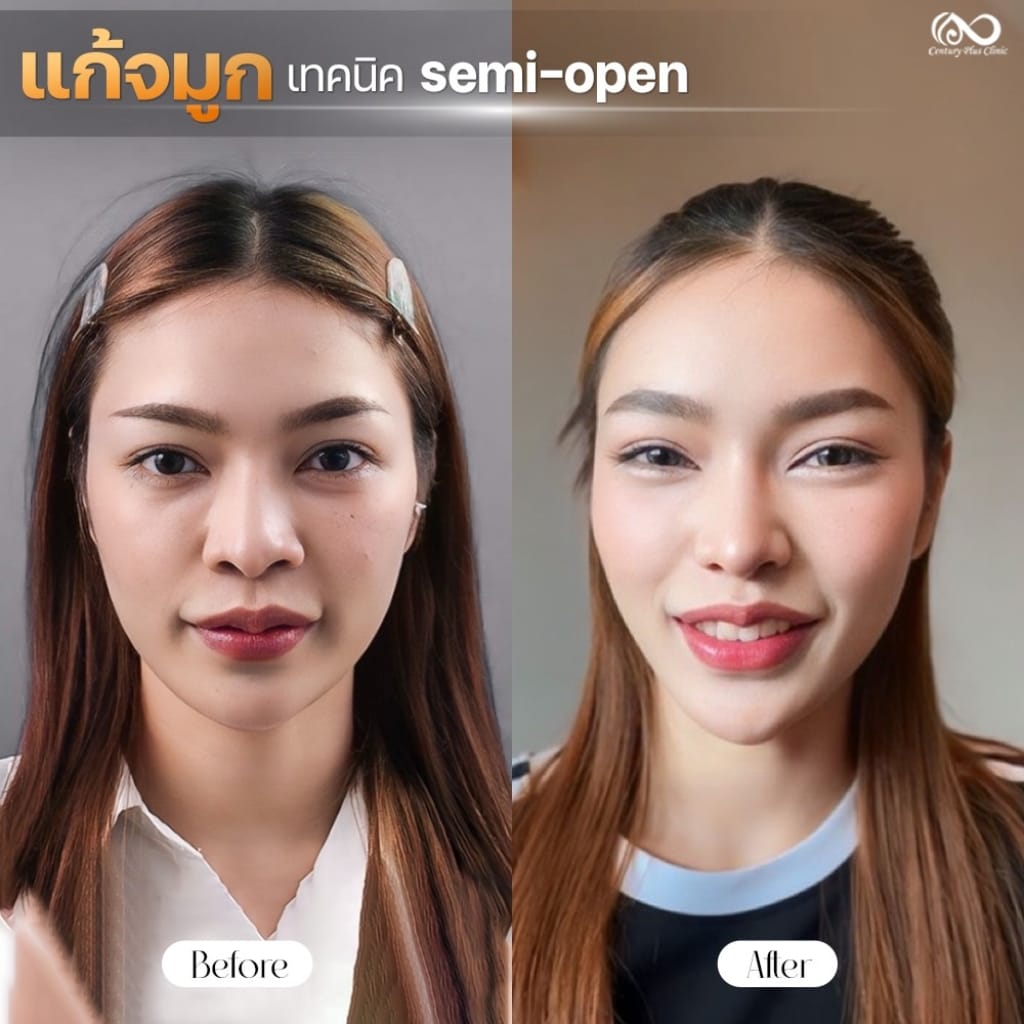 รีวิว แก้จมูก #1275 , Century Clinic Thailand แก้จมูก 2#1275