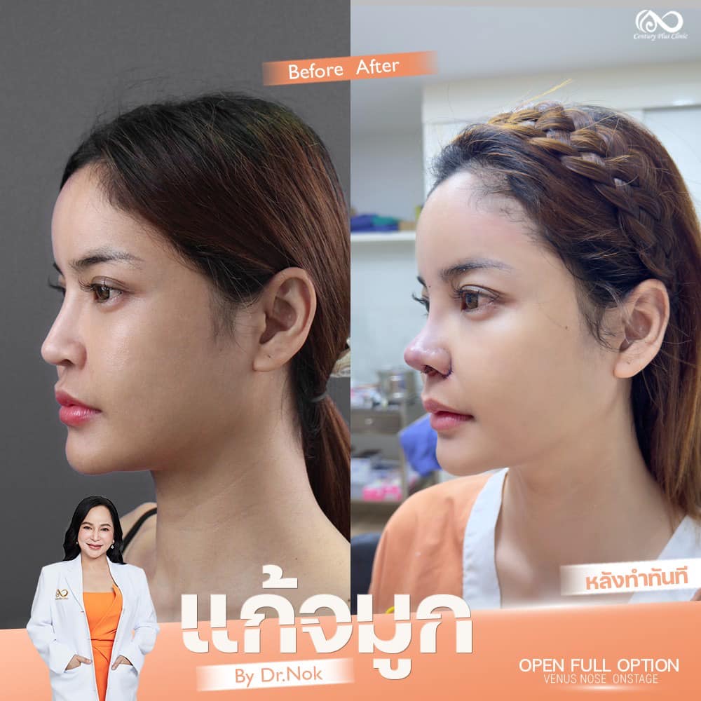 รีวิว แก้จมูก #1304 , Century Clinic Thailand แก้จมูก 2#1304