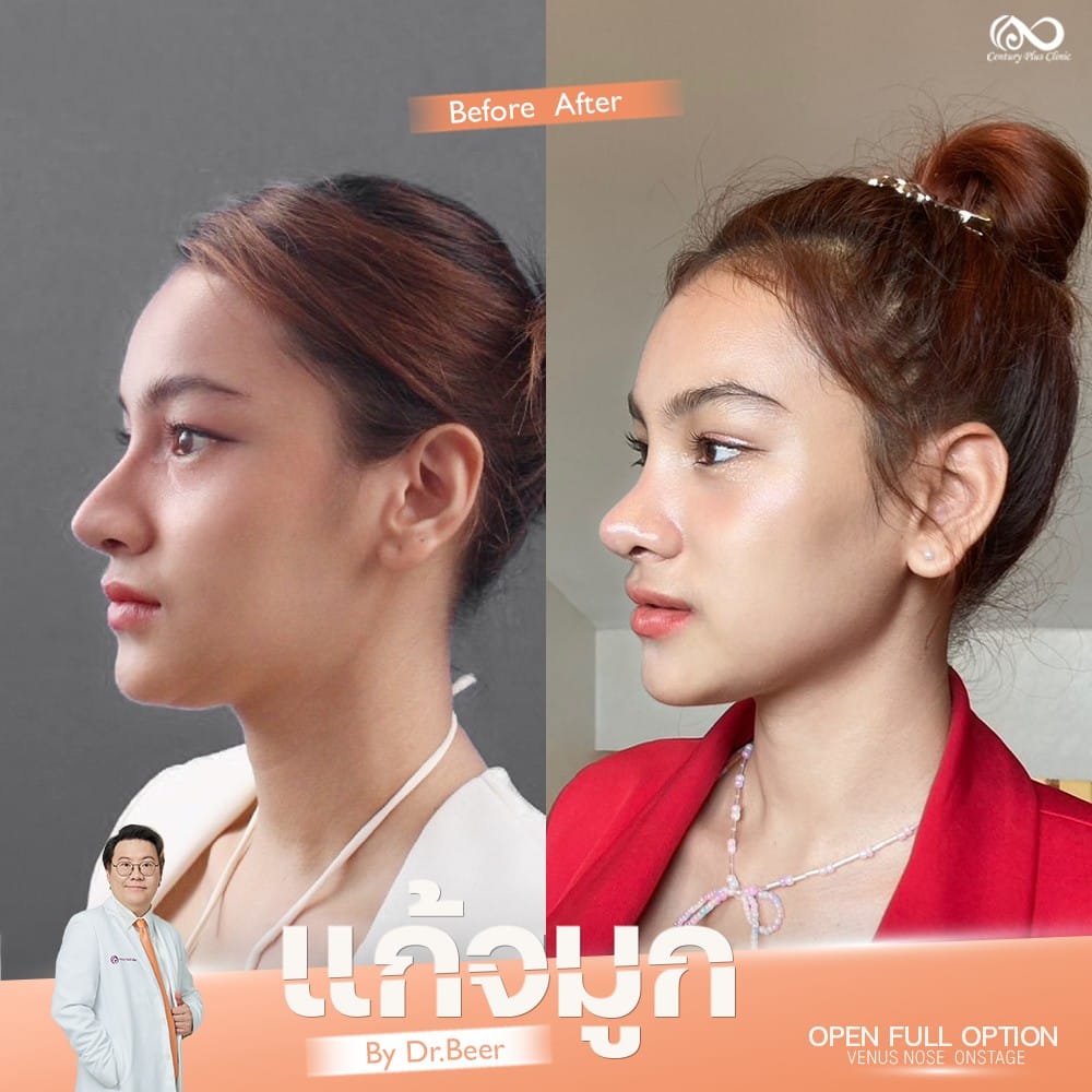 แก้จมูก 2#1308