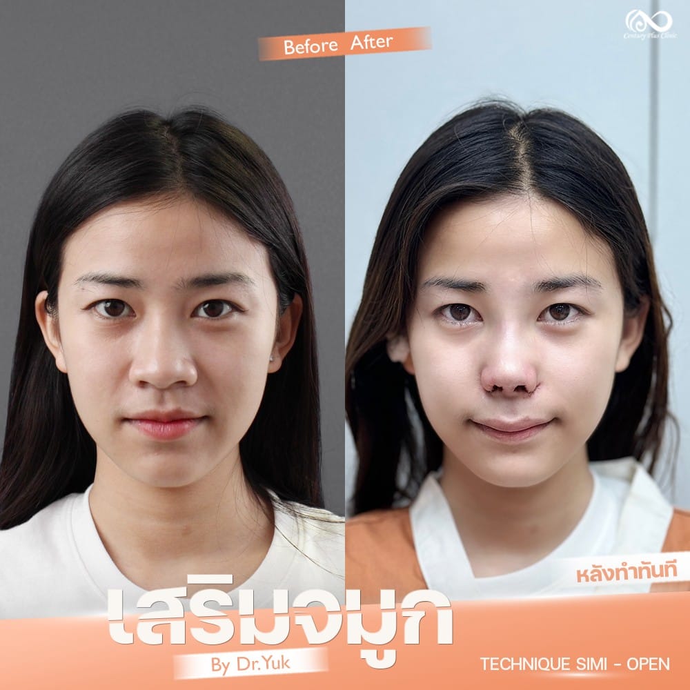 รีวิว เสริมจมูก #1317 , Century Clinic Thailand เสริมจมูก 1#1317