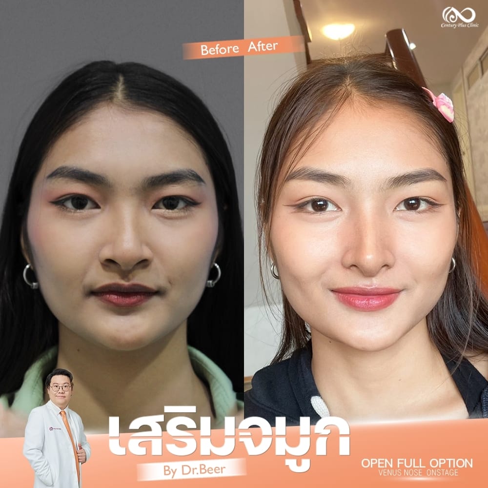 เสริมจมูก 1#1332